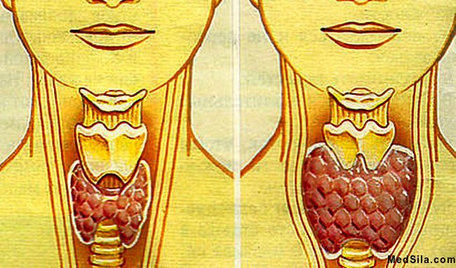 слева железа нормальных размеров, справа значительно увеличенная